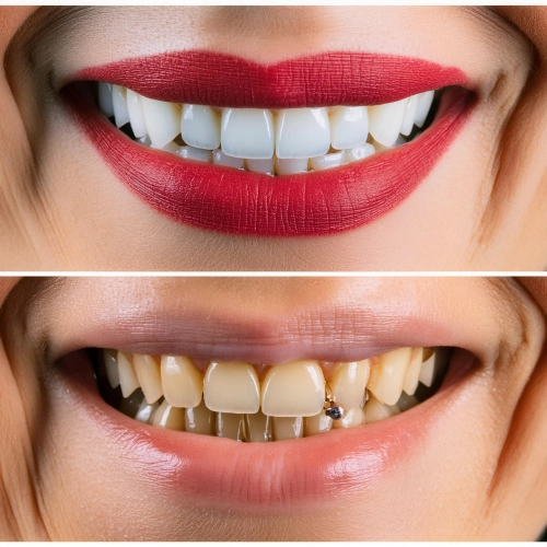 Профессиональная чистка зубов: до и после